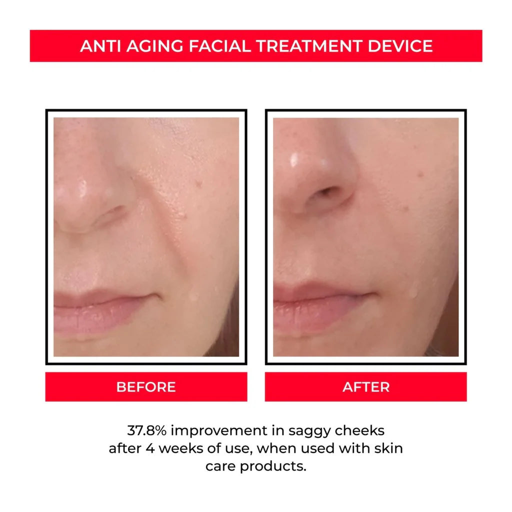 Before and After - 37.8% improvement in saggy cheeks