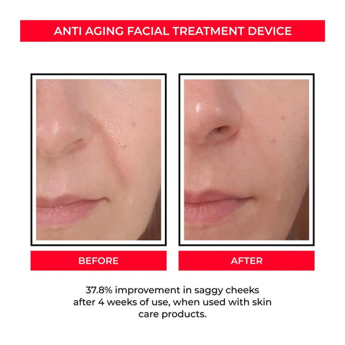 Before and After - 37.8% improvement in saggy cheeks